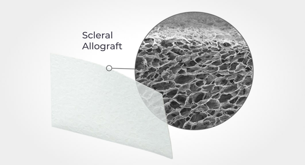 visual representation of a scleral allograft, with a detailed zoomed-in section showing the intricate cellular structure of the tissue, used in AlloFlo