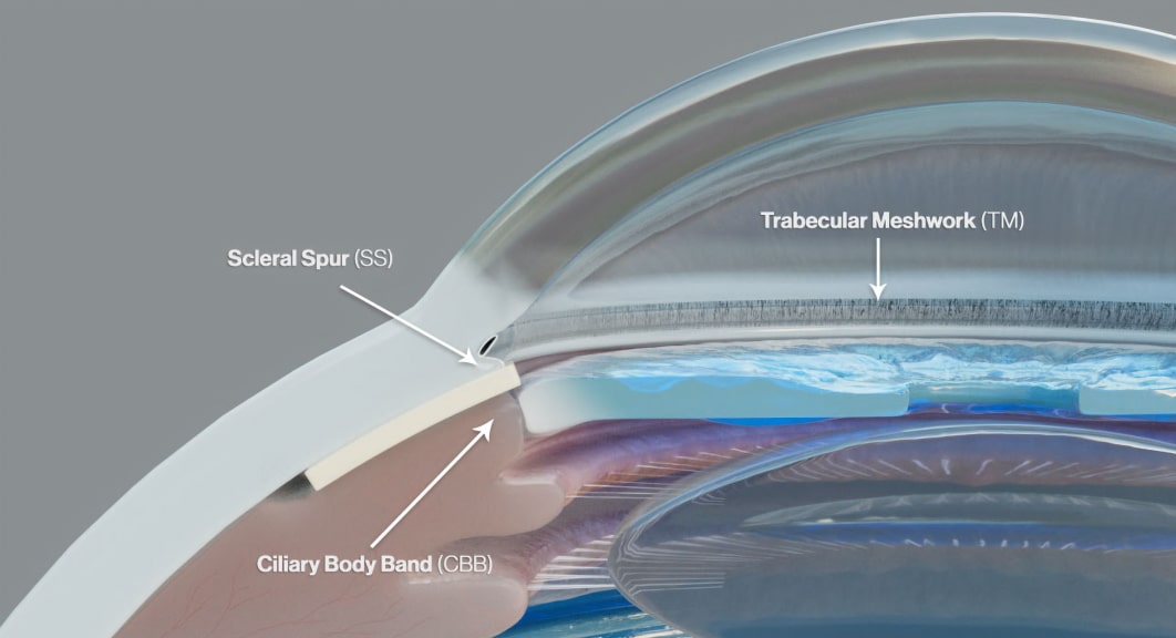 anatomical illustration of the eye, showing the placement of a scleral allograft in relation to the scleral spur, trabecular meshwork, and ciliary body band